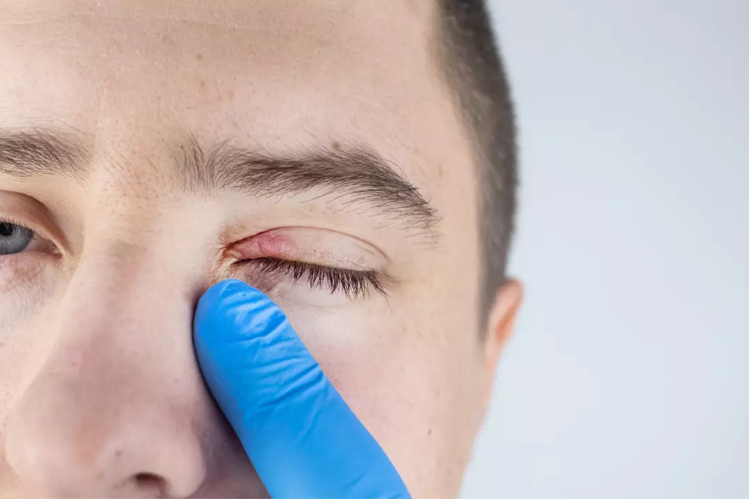 Are eye styes caused by stress