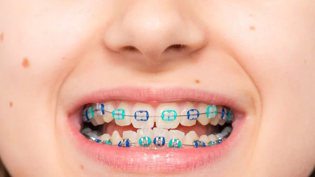 kids braces 2